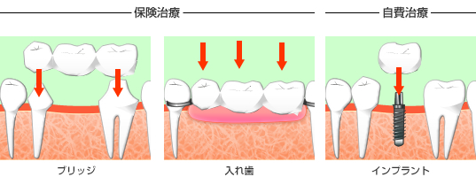 インプラント治療　治療方法　桜新町